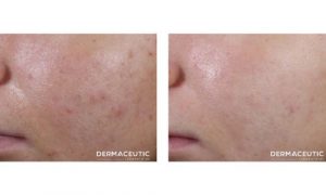 resultaten acne bij Dermaceutic producten - Huidtherapie bij Lori in Zuid Holland