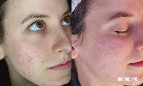 resultaten litteken en acne behandeling Huidtherapie bij Lori Zoetermeer - Zuid-Holland