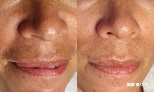 resultaten melasma huidtherapie bij Lori Zoetermeer